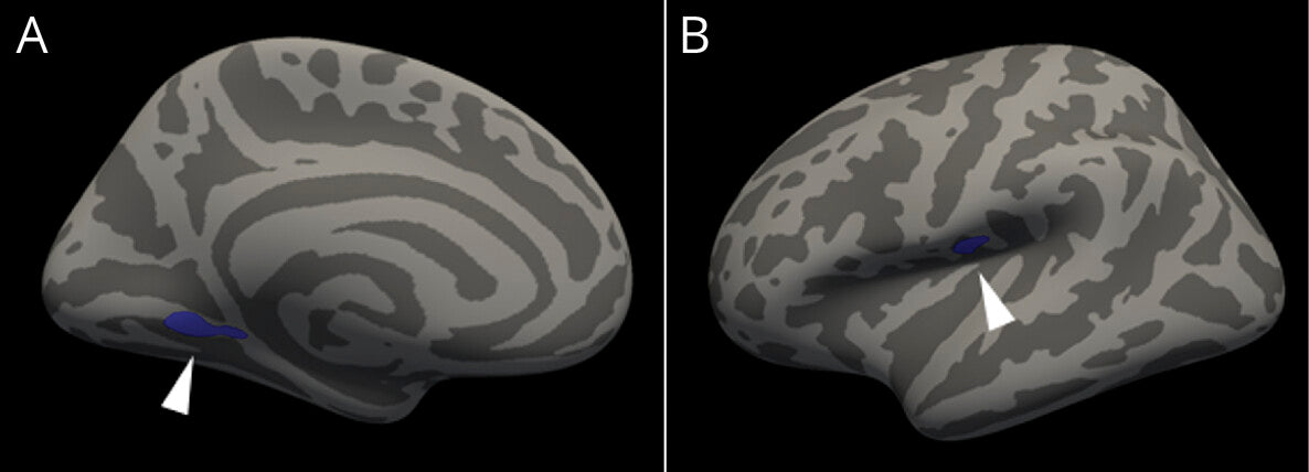 MRI Study Reveals Brain Differences in Patients with Migraine, Offering Hope for Better Diagnostics and Treatment