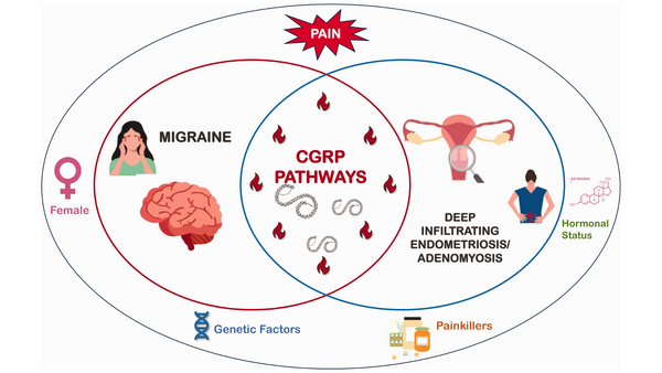 The Link Between Endometriosis and Migraine